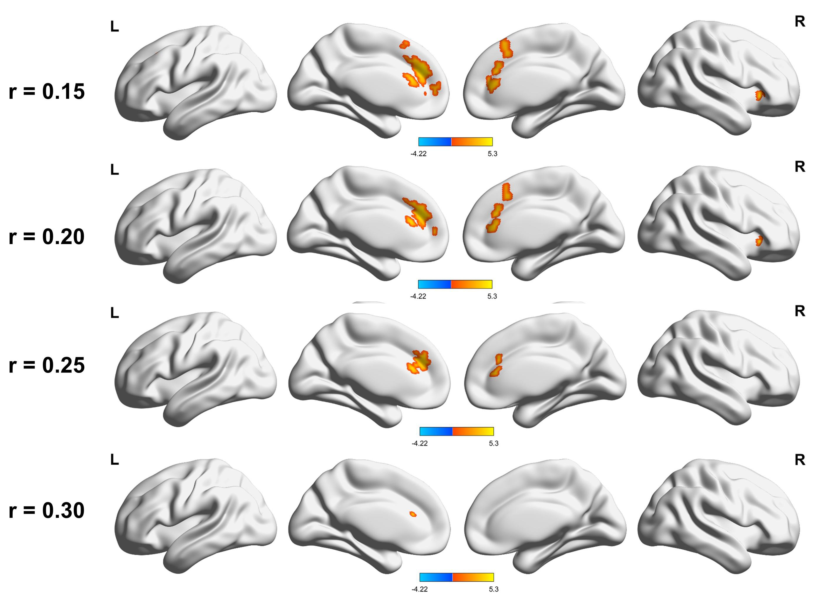 Compared to healthy controls, migraine patients showed 
remarkably similar altered DC brain areas according to different correlation 
thresholds (r0 = 0.15, 0.2, 0.25 and 0.3) (the permutation test with FDR 
corrected p < 0.05). The hot (cool) color indicates significantly 
increased(decreased) DC brain area. Abbreviations: DC: degree centrality; L (R): 
left (right) hemisphere.
