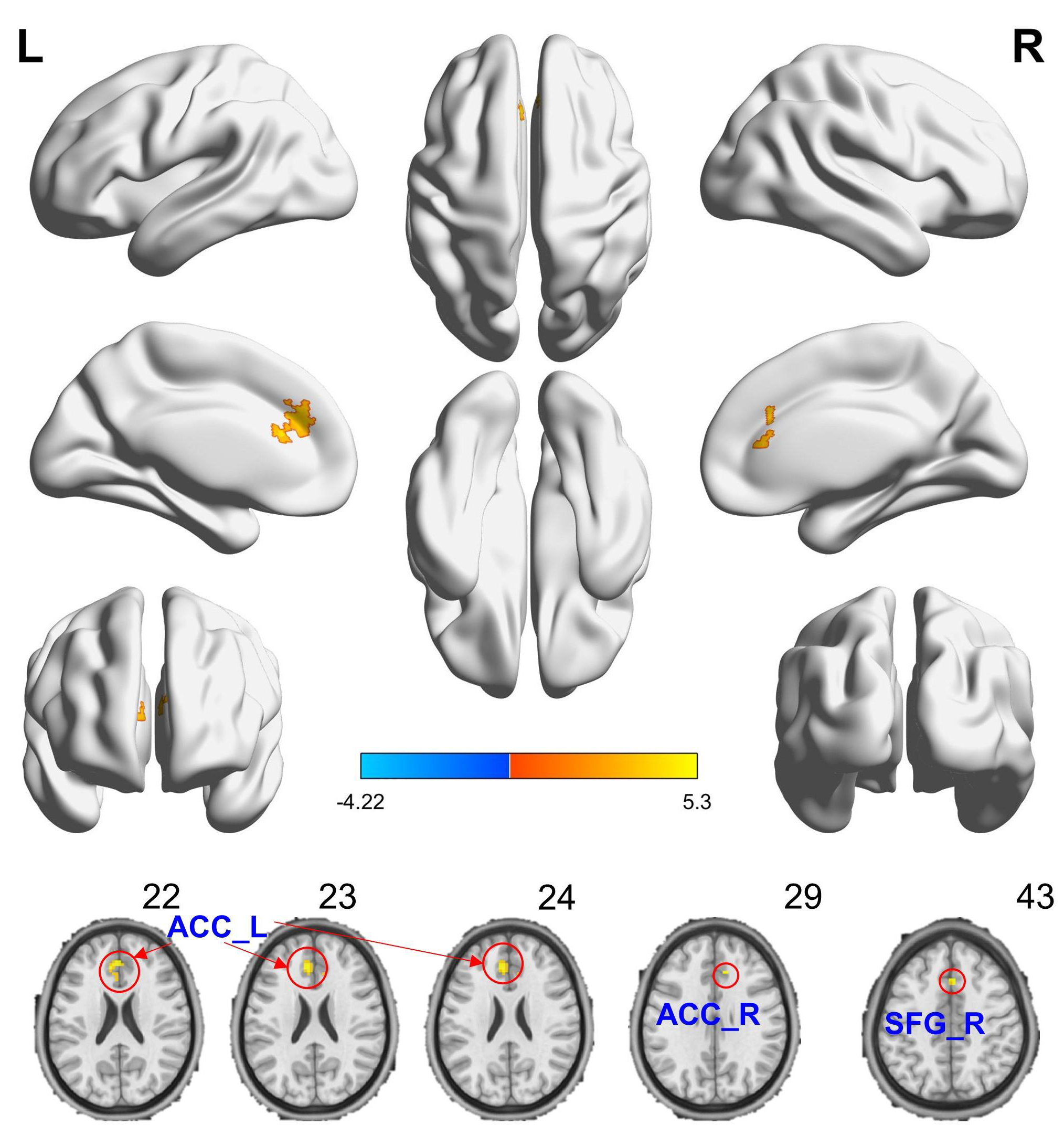 Compared to healthy controls, migraine patients showed that 
increased DC brain areas when r0 was 0.25. The hot (cool) color indicates 
significantly increased (decreased) DC brain area. The hot (cool) color indicates 
significantly increased (decreased) DC brain area. Abbreviations: ACC-L(R): 
anterior cingulate cortex of left(right) hemisphere; SFG-R: superior frontal 
gyrus of right hemisphere.