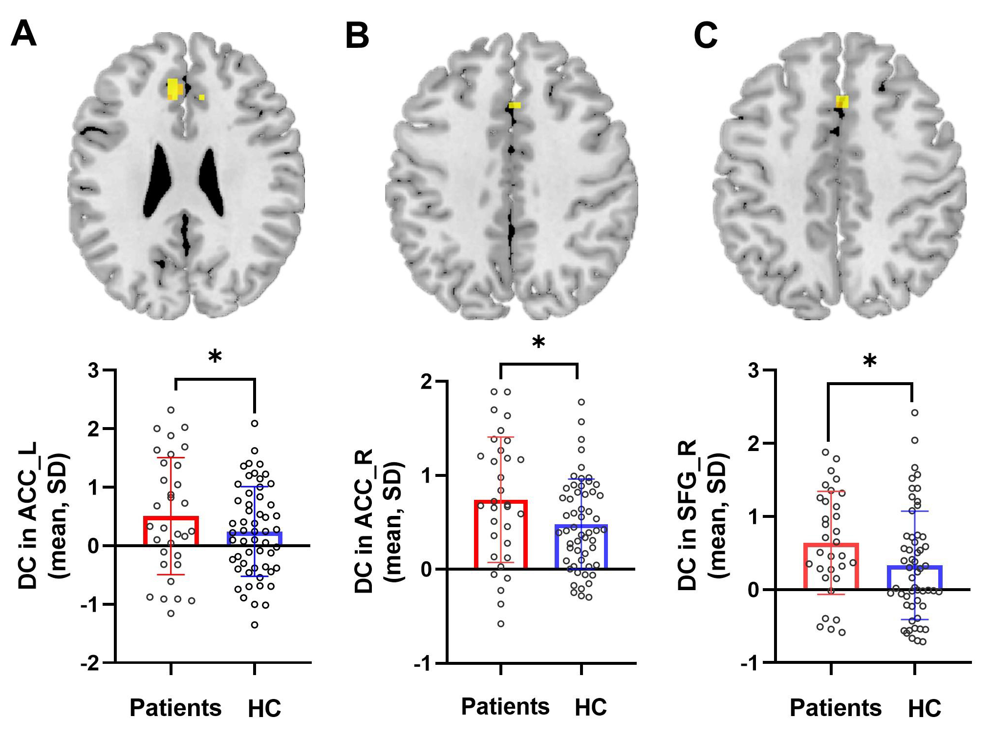 Bar plot of DC for the significant increased clusters between 
migraine patients and healthy controls in the left ACC (A), the right ACC (B) and 
the right SFG (C). Abbreviations: Patients: migraine patients; HC: healthy 
controls; SD: standard deviation; DC: degree centrality; ACC-L(R): anterior 
cingulate cortex of left(right) hemisphere; SFG-R: superior frontal gyrus of 
right hemisphere. *: each bar chart and line segment perpendicular to it 
represent the mean and standard deviation, respectively.