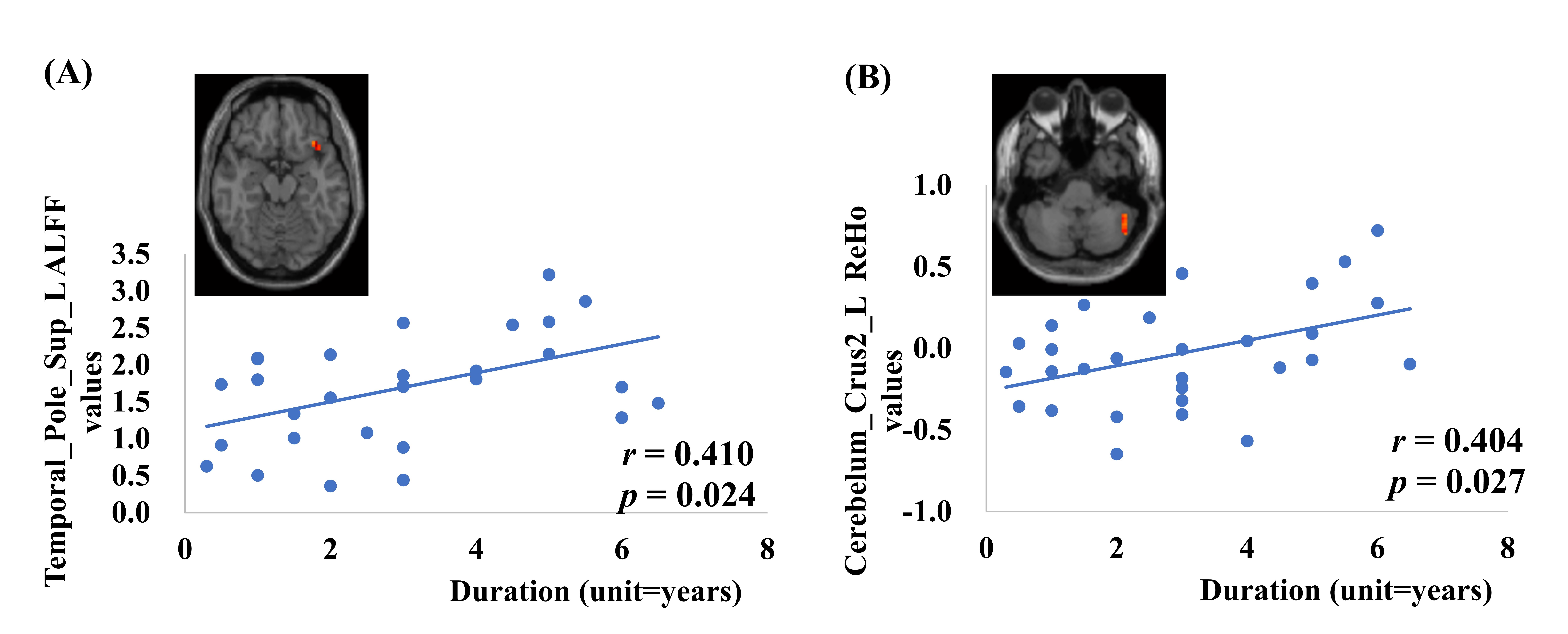 Correlation analysis of meaningful brain regions with disease 
duration and VAS. (A) Positive Correlation Between Disease Duration and ALFF 
Values in Left Temporal Pole Superior for L_TN (r = 0.410, p = 
0.024). (B) Positive Correlation Between Disease Duration and ReHo Values in Left 
Cerebelum Crus2 for L_TN (r = 0.404, p = 0.027). ALFF: 
Amplitude of Low Frequency Fluctuation; ReHo: Regional Homogeneity; L: left; Sup: 
superior.