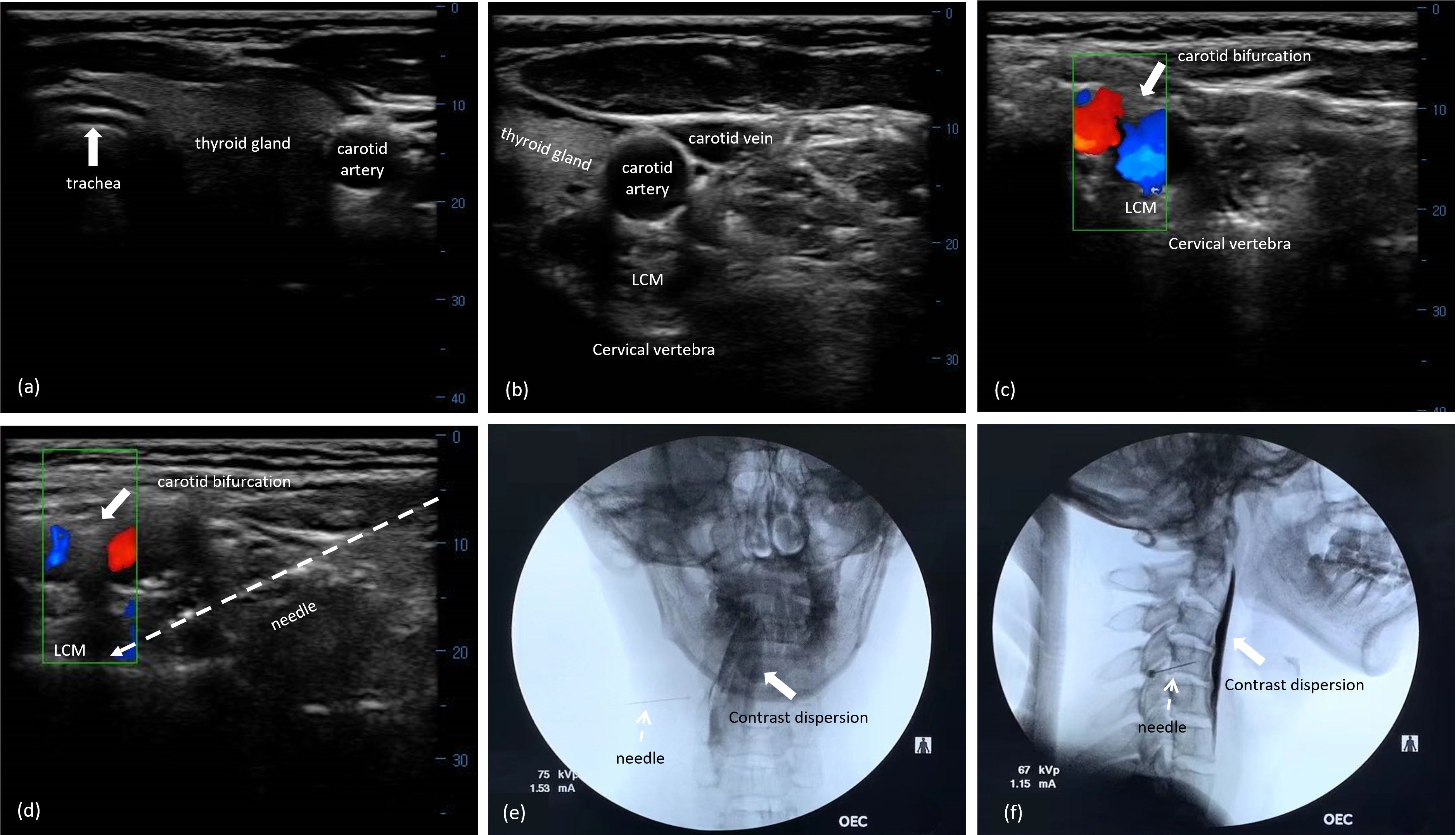 US-guided SCG block with FL verification. (a) Midline structures 
of cervical region including trachea, esophagus and throid gland on the 
transverse US imaging; (b) The right carotid sheath and its’ surrounding 
structures in the lower cervical area; (c) The carotid bifurcation lying on the 
surface of LCM using dopplor model; (d) A needle (white arrows) was visualized 
from the lateral direction toward the targeted SCG between carotid bifuraction 
and LCM at the third cervical segment; (e) The anteroposterior view of FL 
confirmed the precise needle placement and contrast dispersion along cervical 
vertebras; (f) The lateral view of FL showed the needle tip locating at the third 
cervical vertebra and the contrast distribution covering the upper cervical 
segments. LCM: longus capitis muscle; OEC: orthopedic equipment company.
