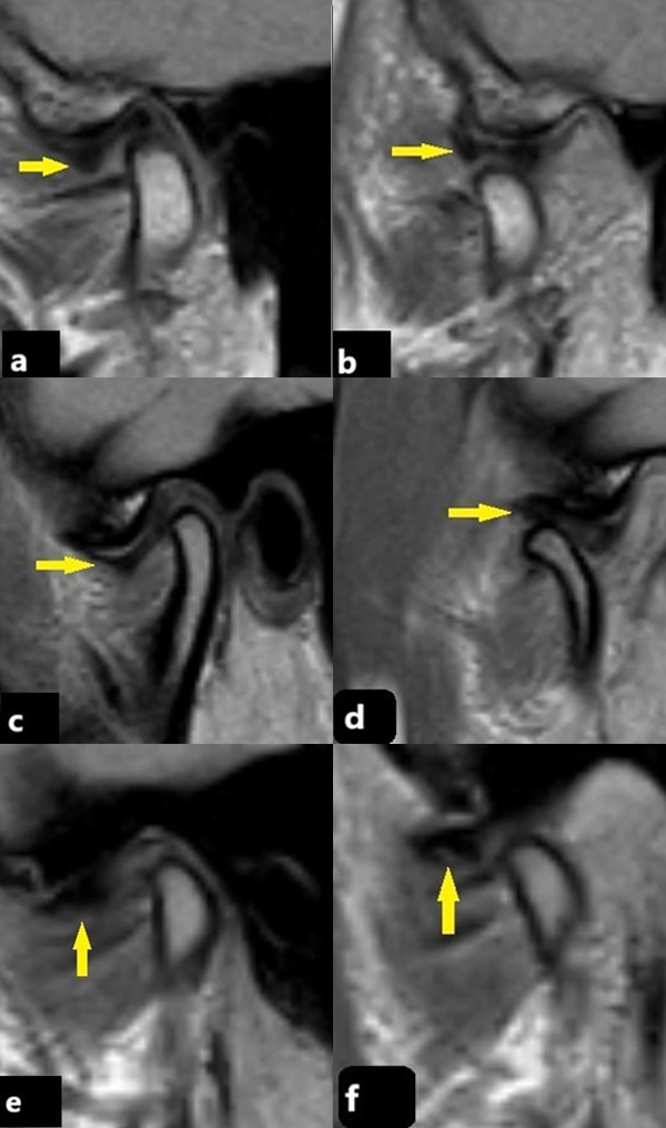 PDW MRI images showing normal disc position and anterior DDWR 
and DDWOR. Arrows show discs on all images. (a,b) Closed-mouth (a) and 
open-mouth (b) PDW images. A normal TMJ with a normal disc was observed. (c,d) 
Closed-mouth (c) and open-mouth (d) PDW images. Anterior DDWR was observed. (e,f) 
Closed-mouth (e) and open-mouth (f) PDW images. Anterior DDWOR was observed.