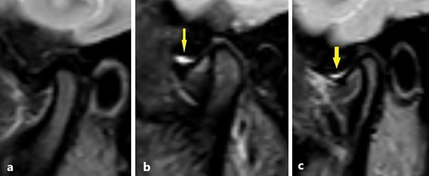 STIR images showing joint effusion. Arrows show the effusion in 
the upper joint space. (a) No effusion. (b,c) presence of effusion.