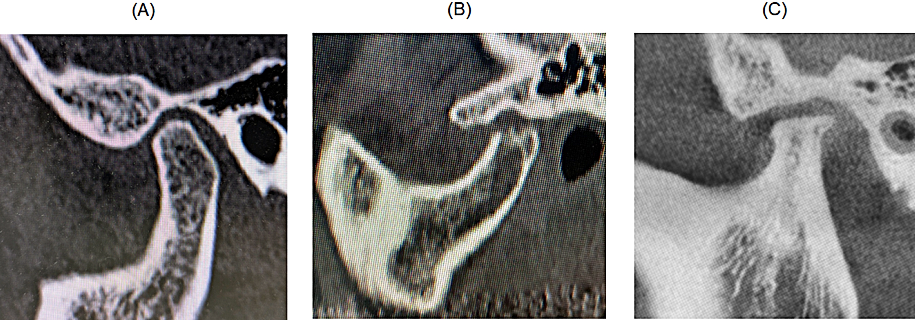 Representative sagittal images of the TMJ. (A) Healthy condyle.
(B) TMJOA condyle. (C) ICR condyle.