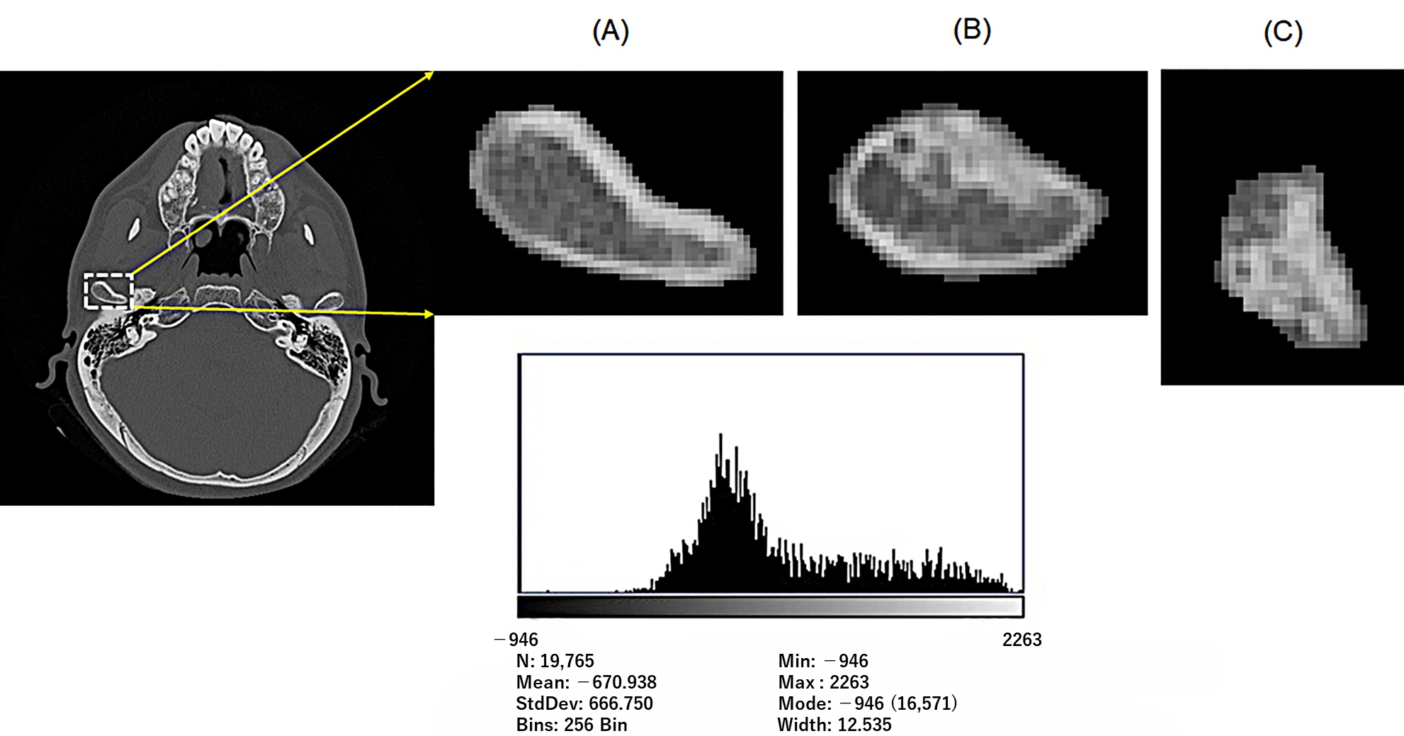 Representative clinical CT image in the axial plane and a
histogram of HU values. (A) Healthy condyle. (B) TMJOA condyle. (C) ICR condyle.
Min: the minimum HU value; Max: the maximum HU value; StdDev: standard deviation.
The yellow arrows indicate the segmented ROIs of the condyle extracted from the
CT image (A).