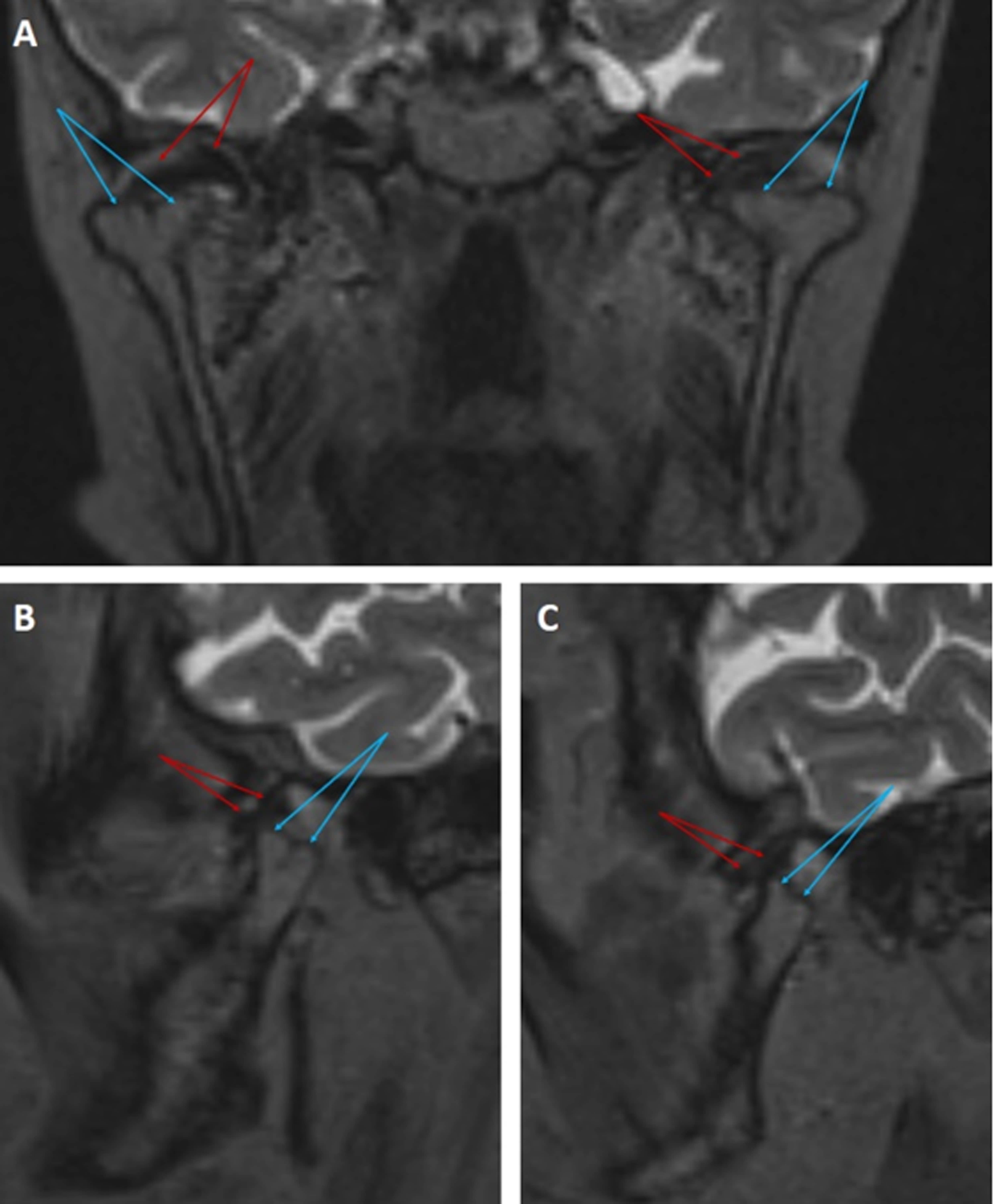 T2-weighted 3D SPACE MR findings of the
temporomandibular joint in a case of bifid mandibular condyle. Coronal (A) and
sagittal (B and C) plane T2-weighted 3D SPACE images demonstrating bilateral
bifid mandibular condyles (double blue arrows). The mandibular condyles are
positioned in a subluxed appearance toward the level of the articular eminence.
On the right, the TMJ disc is thickened, whereas on the left, the disc shows
increased signal intensity (double red arrows).