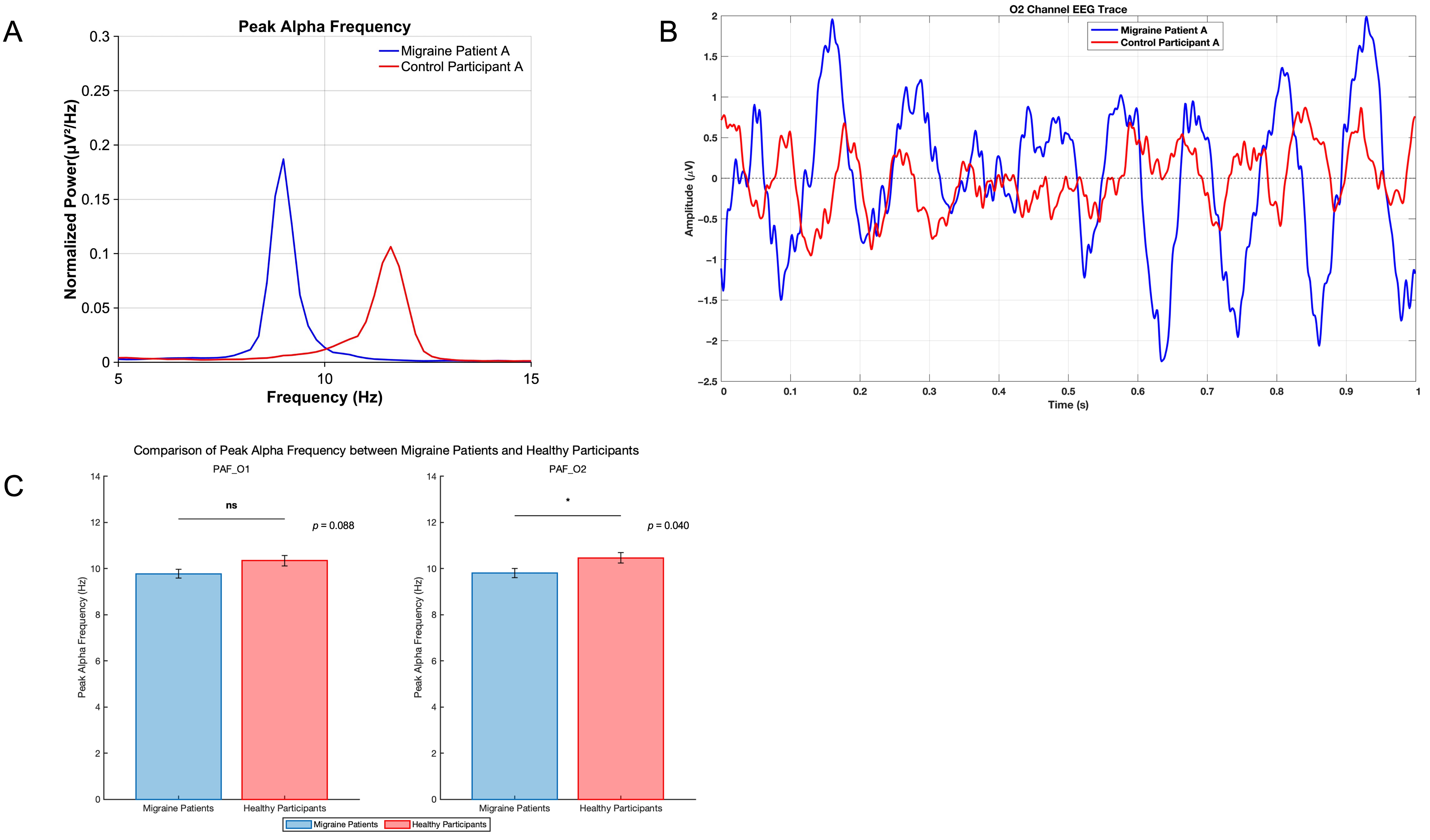 PAF illustration and comparison. (A) Normalized power
(μV2/Hz) as a function of frequency (Hz) for Migraine Patient A
and Control Participant A, illustrating the distribution of power and the PAF
within a frequency range of 0.05 to 15 Hz. (B) Averaged EEG trace from the O2
channel for Migraine Patient A and Control Participant A, showing amplitude
(μV) over time (s); the trace highlights differences in the
amplitude of neural oscillations between the two groups. (C) Group comparisons of
PAF measured at occipital electrodes O1 and O2 using the Mann-Whitney U test. The
figure presents PAF values for migraine patients compared to healthy
participants. Error bars represent standard errors. PAF: peak alpha frequency;
EEG: electroencephalography; O1: left occipital cortex; O2: right occipital
cortex; ns: no significant difference. * indicates p < 0.05.