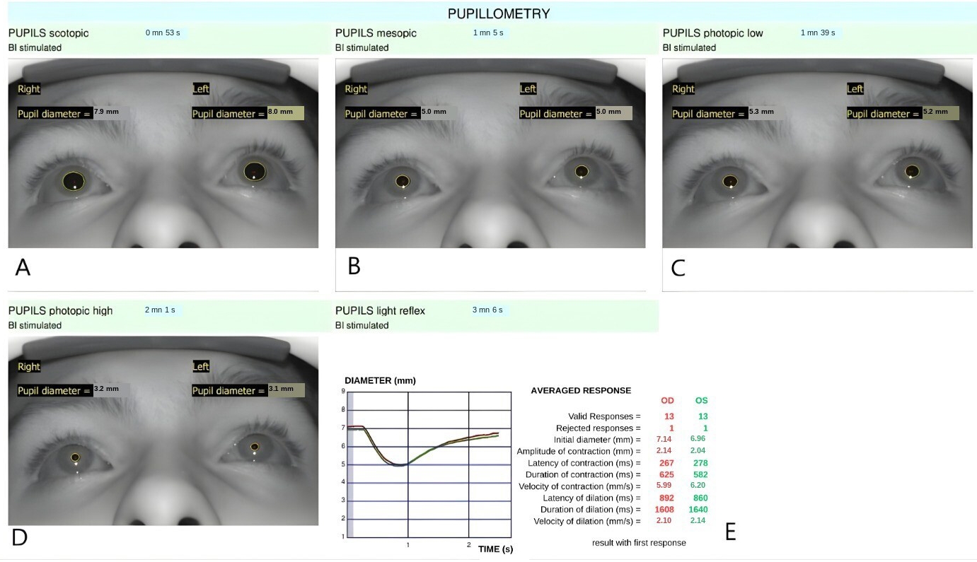 Representative pupillometry recordings obtained under different 
illumination conditions. (A) scotopic, (B) mesopic, (C) low photopic, and (D) 
high photopic illumination. (E) Representative pupillary light reflex response 
curve. BI: Binocular; OD: Oculus Dexter; OS: Oculus Sinister.