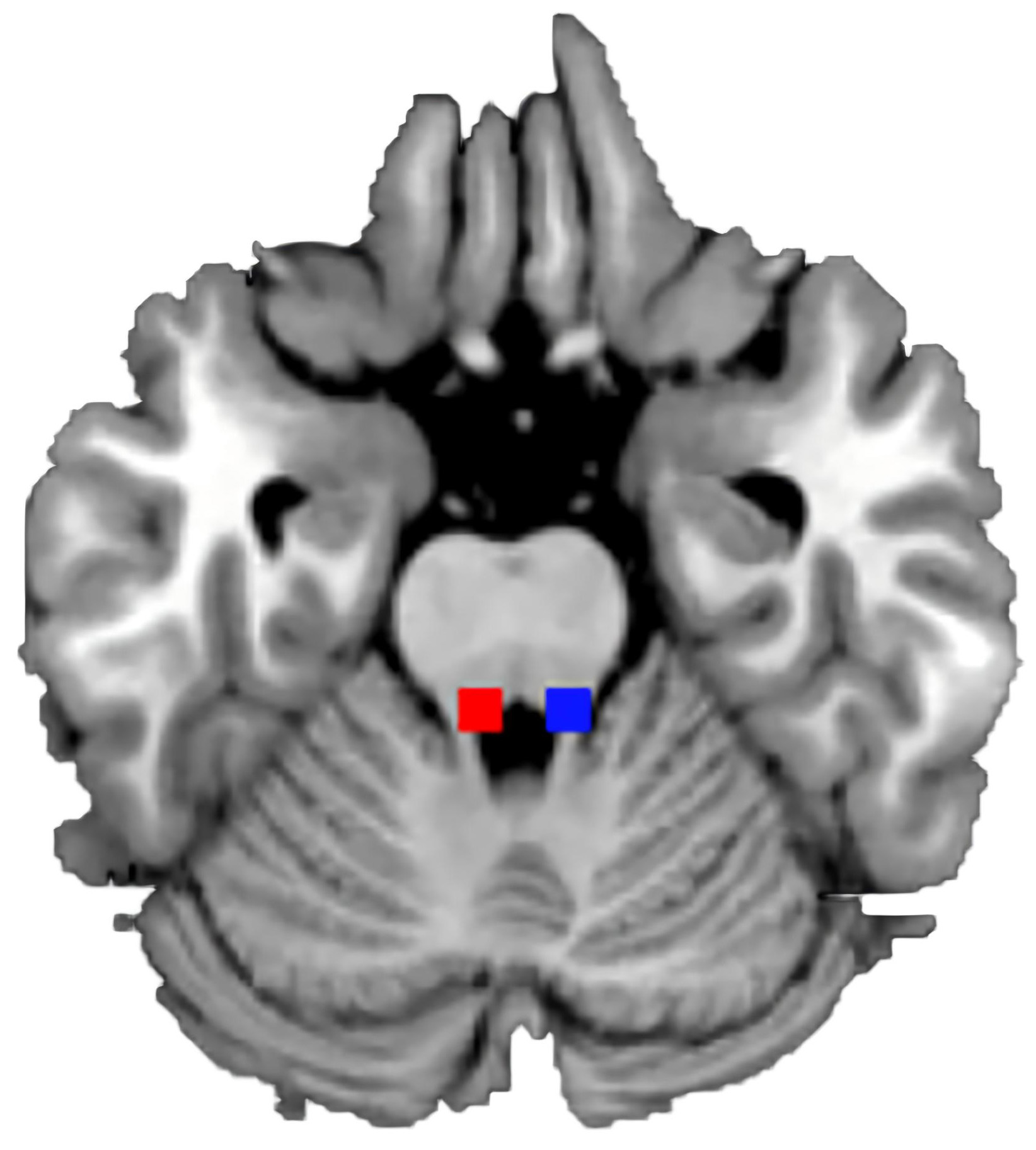 The bilateral Locus Coeruleus seed masks. Masks were 
defined according to Bär (Bär et al. [16], 2016) (combined left 
and right LC; left LC seed was defined as 4 × 6 × 10 mm 
centered at MNI-coordinates −5, −34, −21, and right LC seed was defined as 4 
× 6 × 10 mm centered at MNI-coordinates 7, −34, −21). Blue, 
left locus coeruleus; Red, right locus coeruleus.