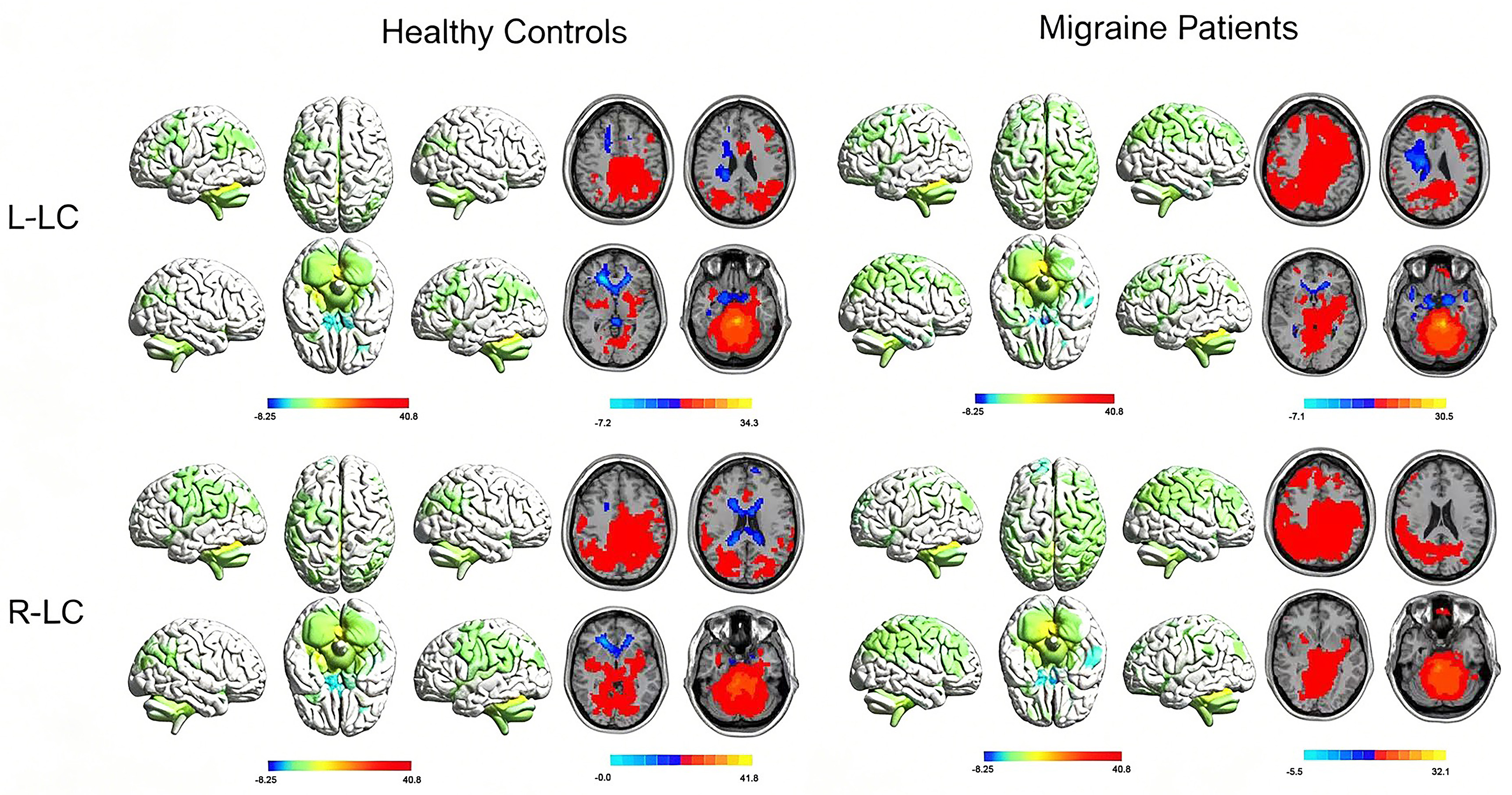 Resting-state functional connectivity maps of the 
bilateral Locus Coeruleus. The Migraine patients, n = 55; the healthy controls, 
n = 50. L, left; R, right; LC, Locus Coeruleus.