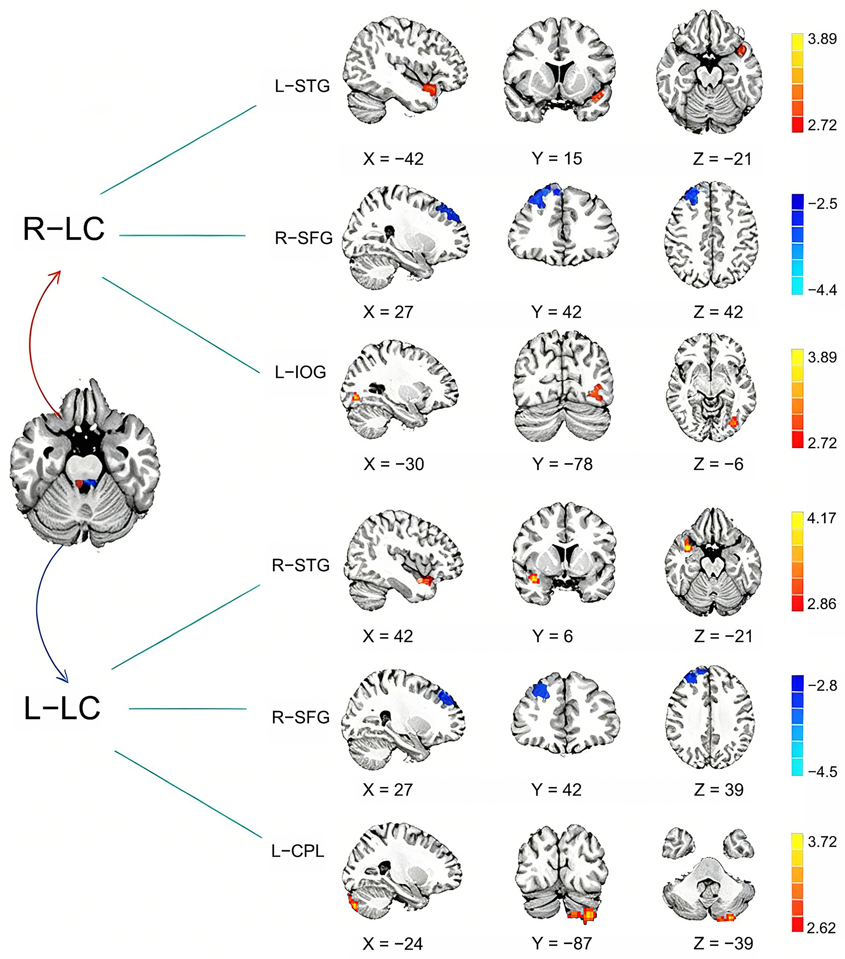 Between-group differences in functional connectivity. Altered 
functional connectivity between the bilateral Locus Coeruleus and whole-brain 
regions in patients with migraine without aura (MwoA) compared with healthy 
controls. L, left; R, right; LC, Locus Coeruleus; SFG, Superior Frontal Gyrus; 
IOG, Inferior Occipital Gyrus; STG, Superior Temporal Gyrus; CPL, Cerebellar 
Posterior Lobe.