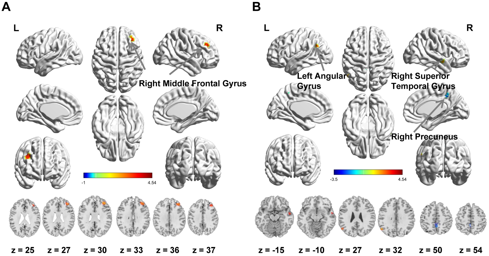 Brain regions with significantly altered ALFF and ReHo after
acupuncture treatment in patients with migraine. (A) Brain regions showing
significantly increased ALFF after acupuncture compared with baseline. (B) Brain
regions showing significantly increased and decreased ReHo after acupuncture
compared with baseline. Warm colors indicate increased ALFF/ReHo, whereas cold
colors indicate decreased ReHo. The numbers beneath the images indicate
z-coordinates of the slices in MNI space. L, left; R, right.