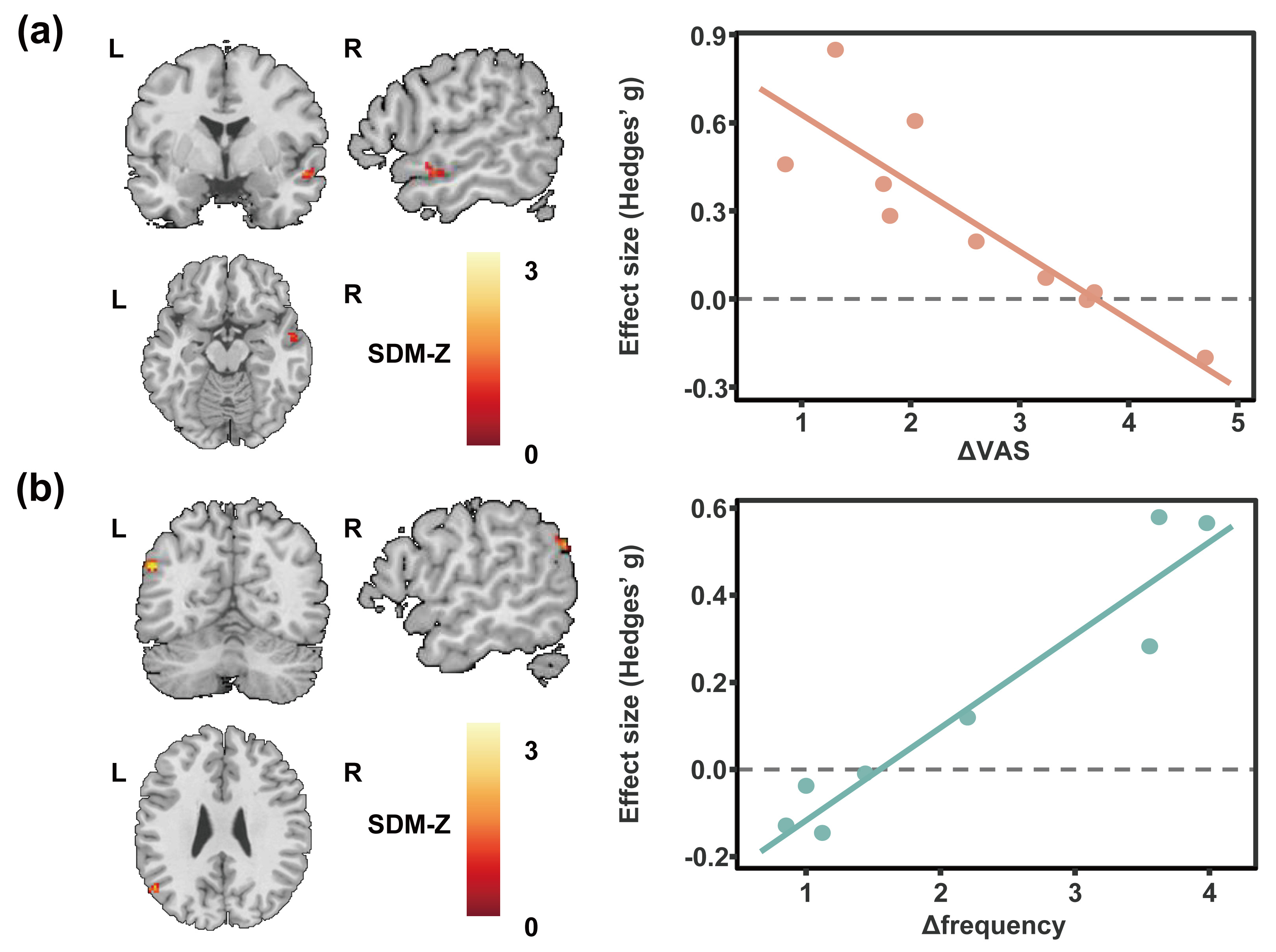 Exploratory meta-regression results (uncorrected p <
0.05, cluster size ≥10 voxels). (a) ΔVAS was negatively
associated with ReHo in the right superior temporal gyrus. (b)
Δfrequency was positively associated with ReHo in the left angular
gyrus. L, left; R, right; SDM, seed-based d mapping; ReHo, regional homogeneity;
VAS, Visual Analogue Scale; ΔVAS, pre-treatment minus post-treatment VAS
score; Δfrequency, pre-treatment minus post-treatment migraine attack
frequency.