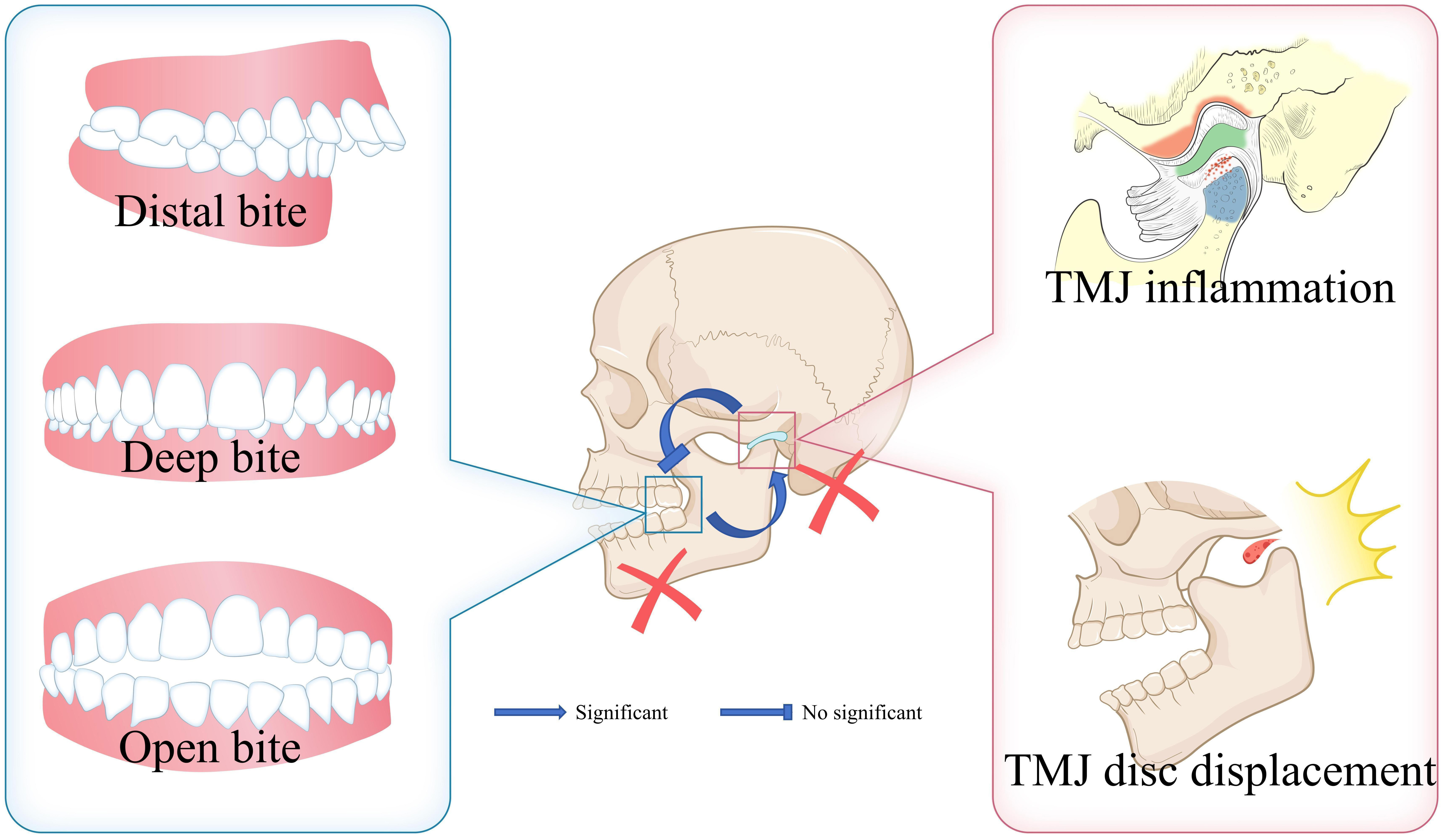 Summary of the relationship between TMD and malocclusion. TMJ:
temporomandibular joint.
