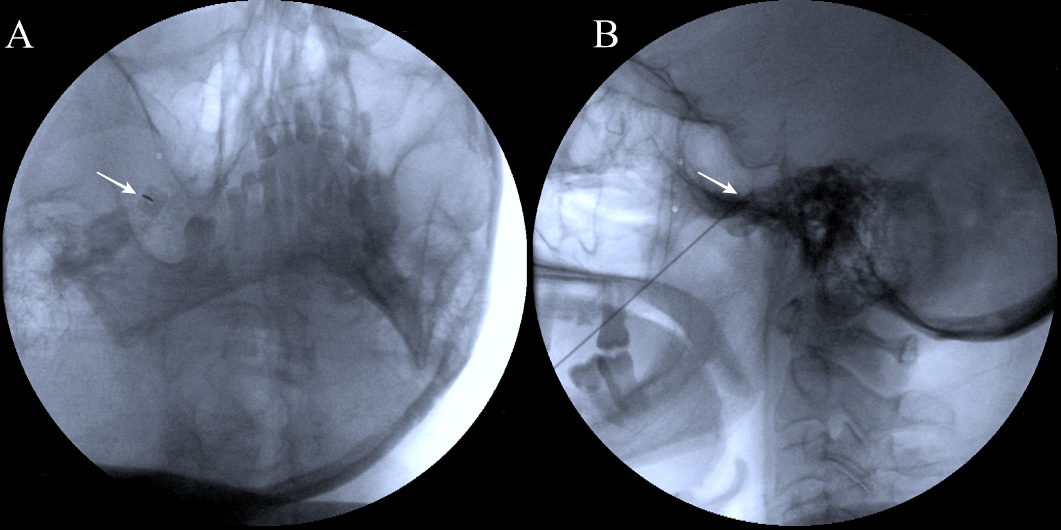 Representative fluoroscopic anteroposterior (A) and lateral (B)
views obtained during Gasserian ganglion conventional radiofrequency cannulation
through the foramen ovale. In the anteroposterior view, the arrow indicates the
foramen ovale and fluoroscopic tunnel view of the radiofrequency cannula. In the
lateral view, the arrow indicates the needle tip positioned adjacent to the
Gasserian ganglion.