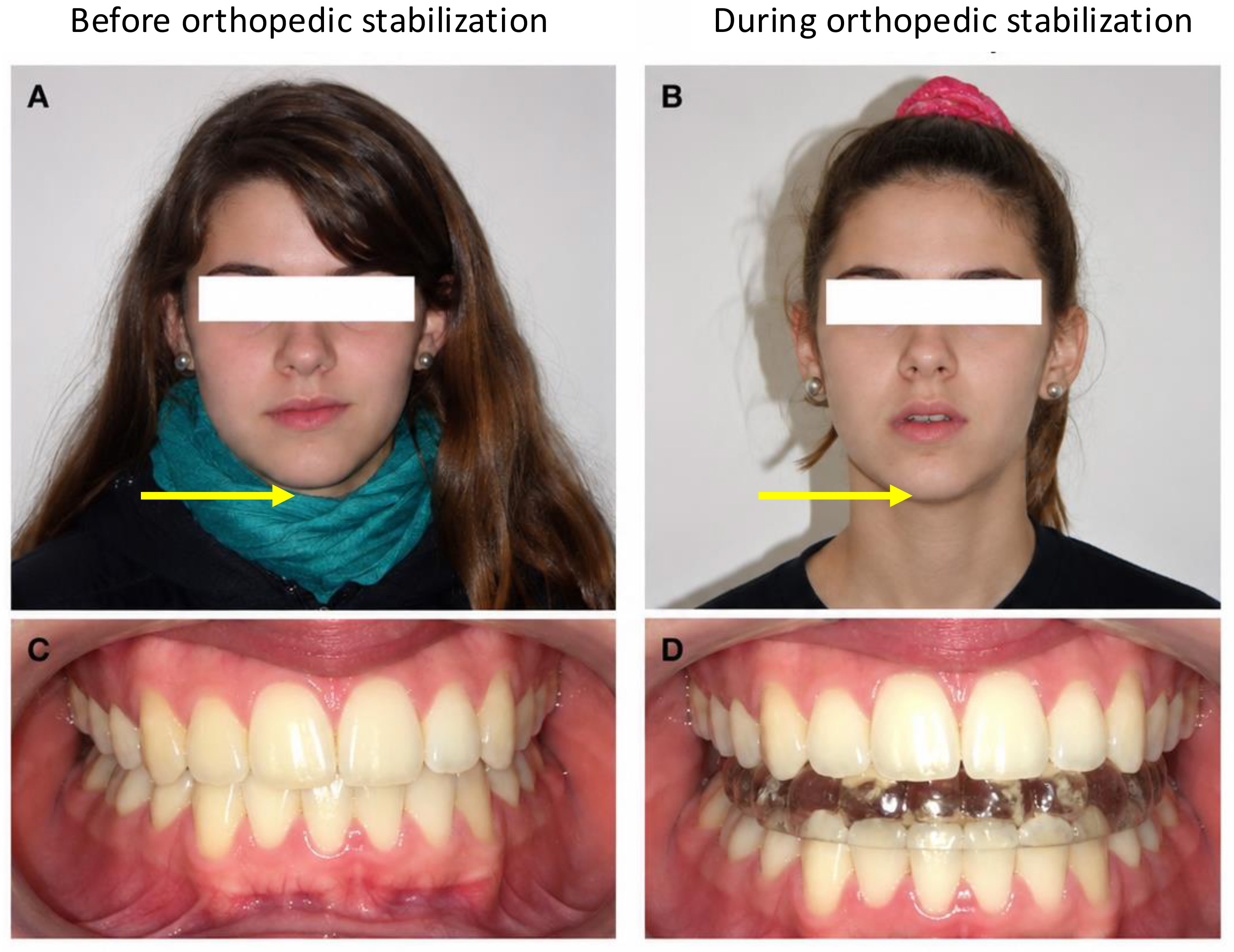 Representative clinical
effects of orthopedic stabilization. Representative clinical photographs
obtained from the same patient before treatment and during full-time orthopedic
stabilization. (A) Pretreatment frontal view demonstrating facial asymmetry and
mandibular deviation. (B) Frontal view obtained during orthopedic stabilization
showing improved mandibular centering. (C) Pretreatment occlusal relationship.
(D) Occlusal relationship with the orthopedic appliance in place, illustrating
stabilization of mandibular position. These photographs are presented for
illustrative purposes only and were not included in the quantitative analyses.
Yellow arrows indicate the direction of mandibular deviation and its correction
during orthopedic stabilization.