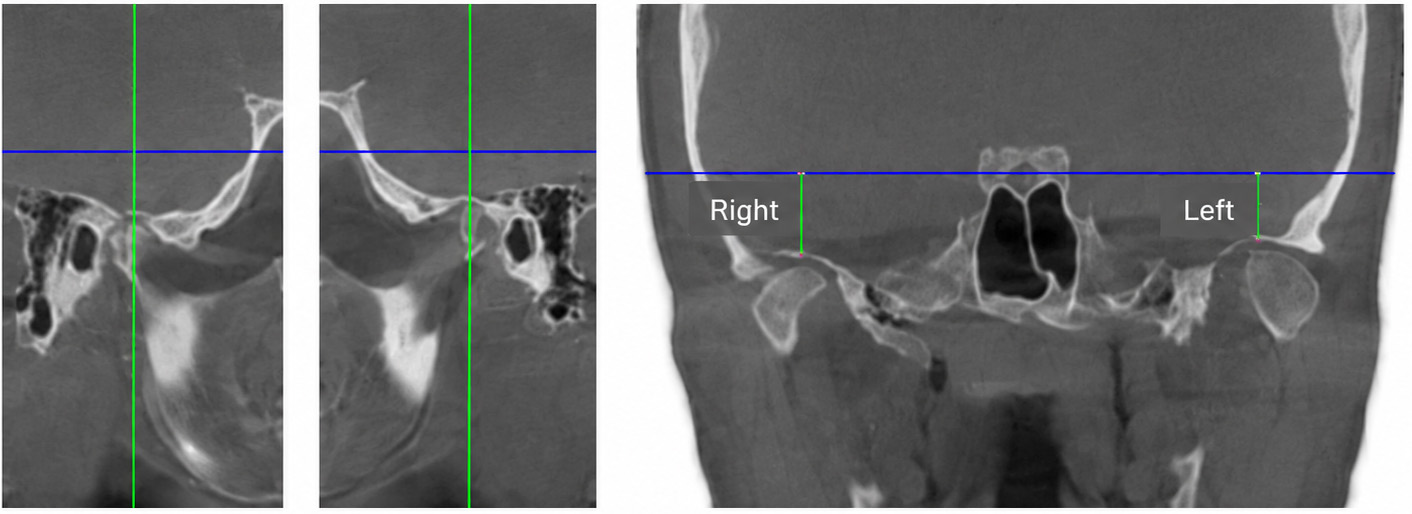 Representative CBCT images
of active unilateral left condylar hyperplasia. Bilateral sagittal and coronal
reconstructions demonstrate condylar asymmetry. The coronal reference lines
illustrate the relationship between each glenoid fossa and a true horizontal
plane, highlighting the adaptive remodeling of the left glenoid fossa associated
with condylar hyperplasia.
